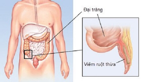 Đau vùng chậu phải do đau ruột thừa